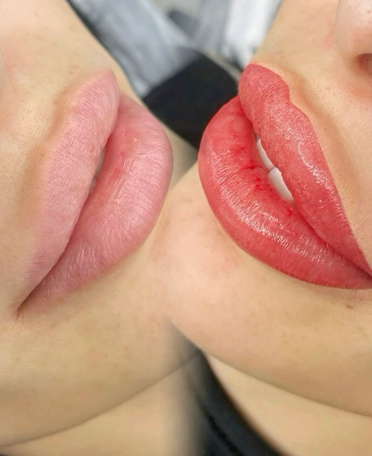 Antes y después inmediato de micropigmentación de labios en Valladolid