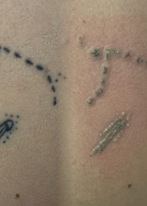 Proceso de eliminación de tatuaje con láser en Valladolid durante la sesión