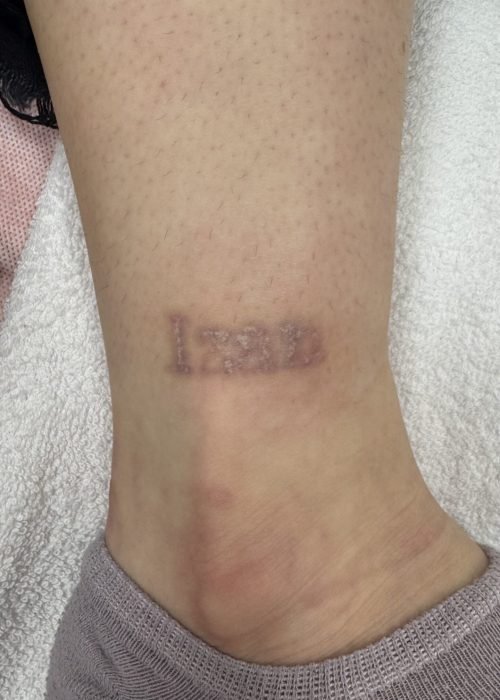 Eliminación de tatuaje con láser en Valladolid durante el proceso