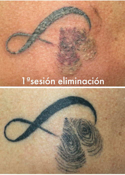 Antes y después de la primera sesión de eliminación de tatuaje con láser en Valladolid
