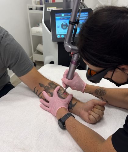Eliminación profesional de tatuajes con láser en Valladolid Sesión de borrado de tatuajes con láser en Valladolid en clínica especializada